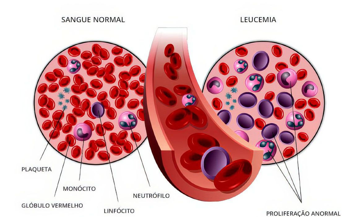 Anvisa Autoriza Pesquisa Em Pacientes Com Leucemia Linfoide Aguda B