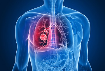 Entenda o que é, e como acontece a embolia pulmonar