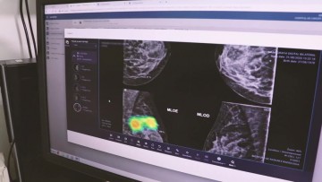 HCP conta com inteligência artificial para ter diagnóstico precoce do câncer de mama