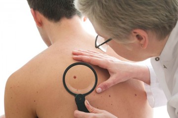 Câncer de pele corresponde a 27% de todos os tumores malignos no país 