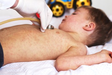 Panorama CBN: Síndrome inflamatória multissistêmica em crianças 