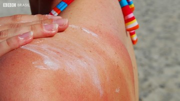 Alta exposição ao sol pode acarretar em doenças na pele, inclusive o câncer