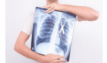 Adenocarcinoma é o subtipo de câncer de pulmão mais frequente do mundo 
