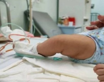 Pernambuco declara situação de emergência na saúde devido à alta ocupação de leitos pediátricos de UTI