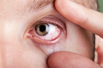 Sintomas da síndrome do olho seco são potencializados no verão 