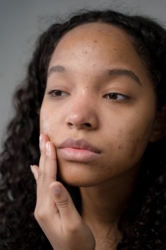 Acne acomete cerca de 80% dos adolescentes, de acordo com a Sociedade Brasileira de Pediatria