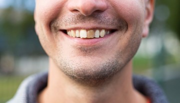 Saúde bucal: saiba as causas das alterações do esmalte dentário e como tratar 