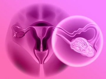 Câncer de ovário: sintomas, causas e tratamento