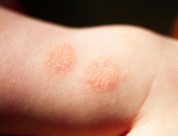 Você sabe o que é dermatite? Especialista esclarece sintomas e tratamento 