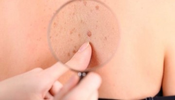 Dermatologista alerta sobre Melanoma 