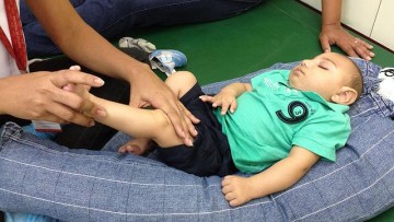 Em Pernambuco, 132 crianças com microcefalia aguardam cirurgias de quadril; Governo divulga cronograma