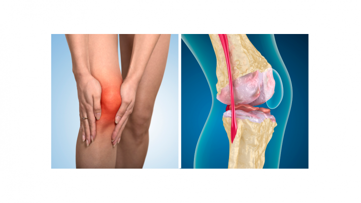 É um tipo de artrite que ocorre quando o tecido flexível nas extremidades dos ossos se desgasta