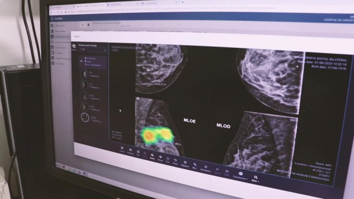 O produto foi desenvolvido por uma startup pernambucana e funciona dentro de um programa de computador que capta as imagens de radiografia e mamografia