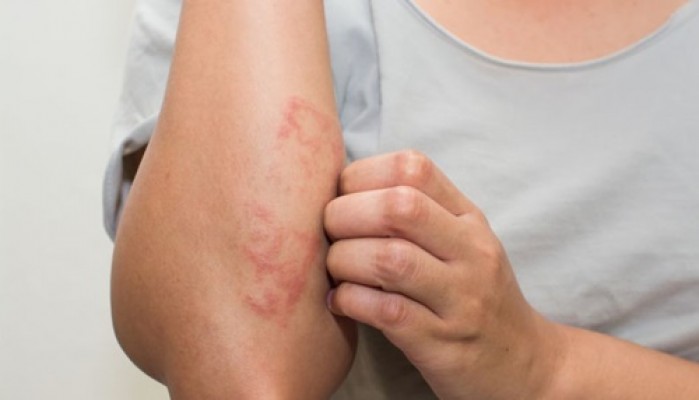 Dermatologista esclarece medidas que devem ser tomadas, caso aconteça penetração da substância na pele