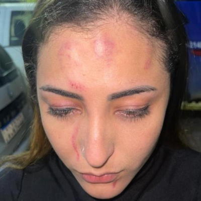 A vocalista de brega da banda Sedutora, Soraya Oliveira, foi espancada por um homem e sua companheira, antes de um show em Vitória de Santo Antão