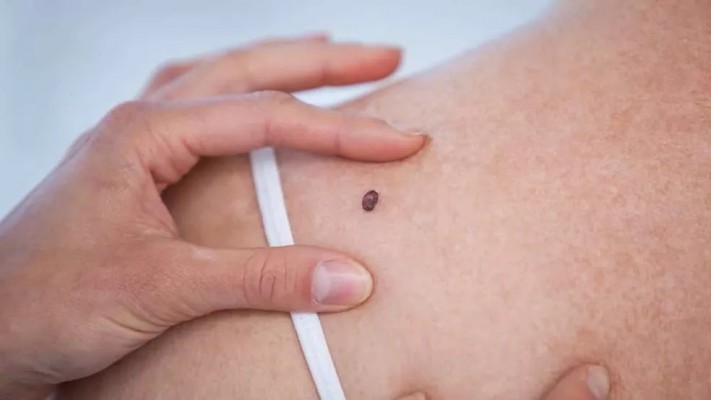 As lesões que podem ser tratadas são as não melanoma, que respondem pela maioria dos casos de câncer de pele entre os brasileiros.