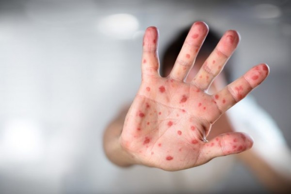 De acordo com a Secretaria de Saúde, as primeiras infecções ocorreram fora do estado. 