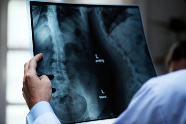 Ortopedista Thiago Pedro esclarece sobre deformidade na coluna vertebral, que atinge cerca de 6 milhões de brasileiros