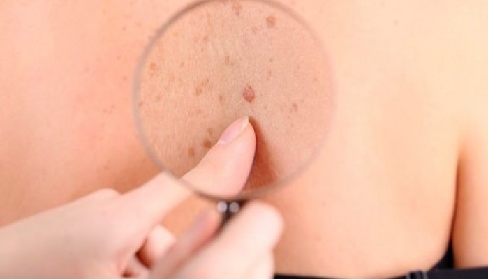 Câncer de pele não é o mais comum, mas é o mais grave  