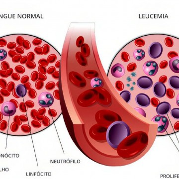 Anvisa autoriza pesquisa em pacientes com leucemia linfoide aguda B