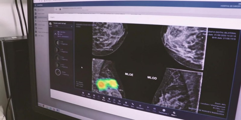 O produto foi desenvolvido por uma startup pernambucana e funciona dentro de um programa de computador que capta as imagens de radiografia e mamografia