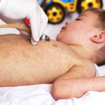 Panorama CBN: Síndrome inflamatória multissistêmica em crianças 