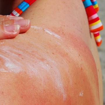 Alta exposição ao sol pode acarretar em doenças na pele, inclusive o câncer