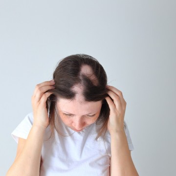 CBN Saúde: Alopecia areata