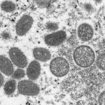Pernambuco notifica mais dois casos de Monkeypox; agora, são 8 em investigação e 3 confirmações 