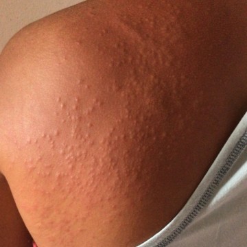 Saiba quais doenças de pele podem acometer pacientes contaminados com água das chuvas