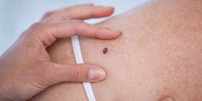 As lesões que podem ser tratadas são as não melanoma, que respondem pela maioria dos casos de câncer de pele entre os brasileiros.