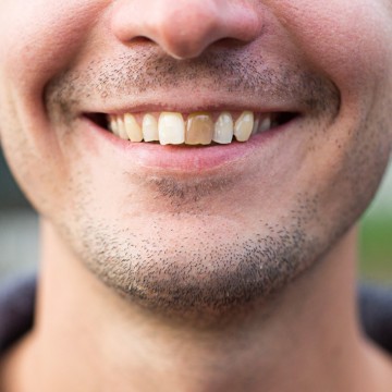 Saúde bucal: saiba as causas das alterações do esmalte dentário e como tratar 
