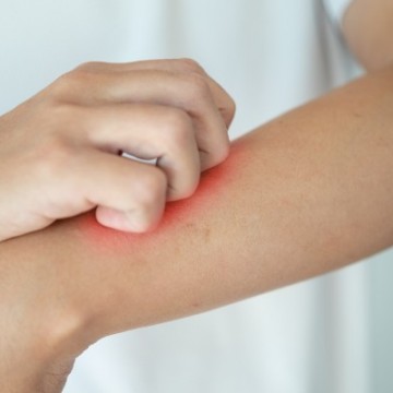 Erisipela: dermatologista explica sobre causas, sintomas e tratamento 