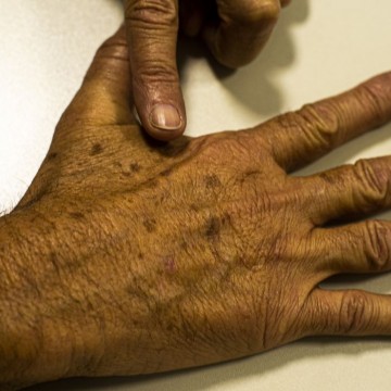 Tecnologia para tratar câncer de pele é aprovada para uso no SUS