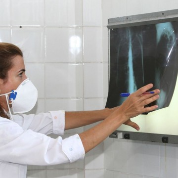 Governo cria comitê para reduzir casos de tuberculose até 2030